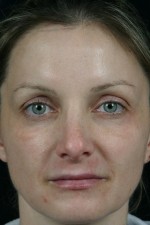 Laser Skin Resurfacing Before and after photo