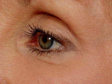 Laser Skin Resurfacing before and after photo