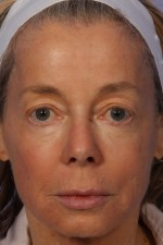 Laser Skin Resurfacing