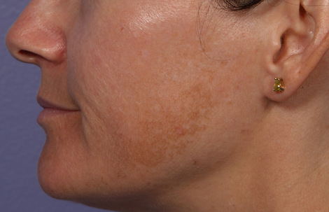 Laser Skin Resurfacing before and after photo