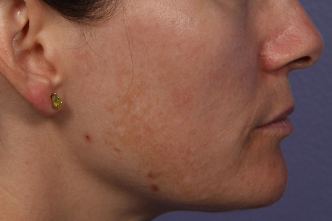 Laser Skin Resurfacing before and after photo