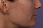 Laser Skin Resurfacing Before and after photo