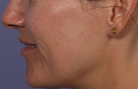 Laser Skin Resurfacing before and after photo