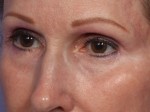 Laser Skin Resurfacing Before and after photo