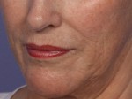 Laser Skin Resurfacing Before and after photo