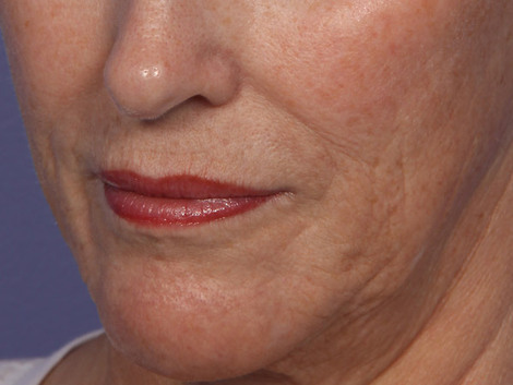 Laser Skin Resurfacing before and after photo