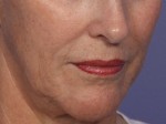 Laser Skin Resurfacing Before and after photo