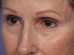 Laser Skin Resurfacing Before and after photo