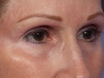 Laser Skin Resurfacing Before and after photo