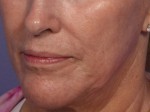 Laser Skin Resurfacing Before and after photo