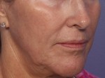 Laser Skin Resurfacing Before and after photo