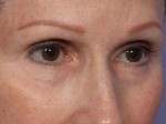 Laser Skin Resurfacing Before and after photo