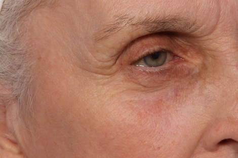 Laser Skin Resurfacing before and after photo