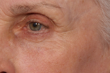 Laser Skin Resurfacing before and after photo