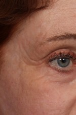 Laser Skin Resurfacing Before and after photo