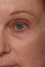 Laser Skin Resurfacing Before and after photo