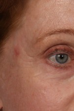 Laser Skin Resurfacing Before and after photo