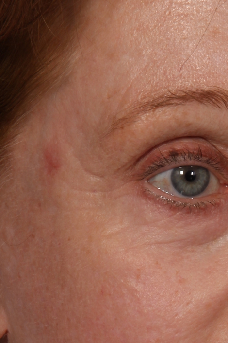 Laser Skin Resurfacing before and after photo