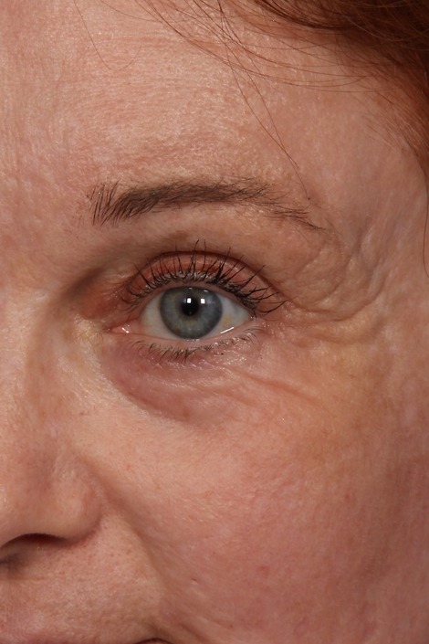 Laser Skin Resurfacing before and after photo