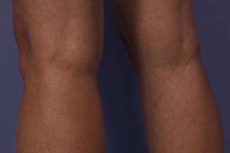 Vein Treatment before and after photo