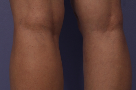 Vein Treatment before and after photo