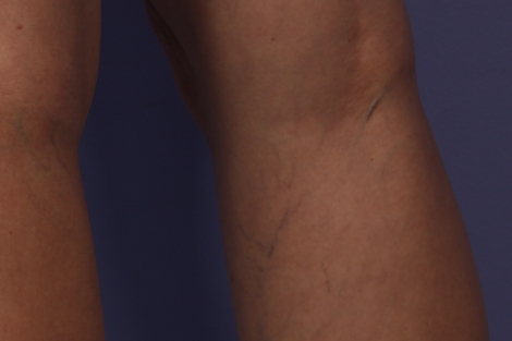 Vein Treatment before and after photo