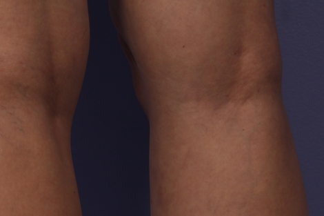 Vein Treatment before and after photo