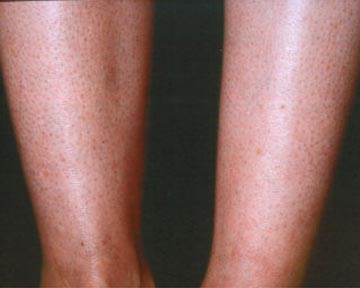 Vein Treatment before and after photo