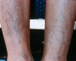 Vein Treatment Before and after photo