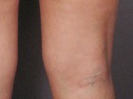 Vein Treatment Before and after photo