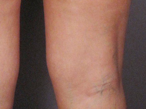 Vein Treatment before and after photo