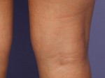 Vein Treatment Before and after photo