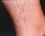 Vein Treatment