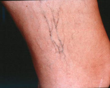 Vein Treatment before and after photo