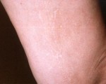 Vein Treatment Before and after photo