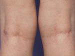 Vein Treatment Before and after photo