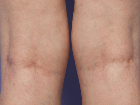 Vein Treatment before and after photo