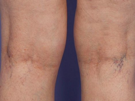 Vein Treatment before and after photo