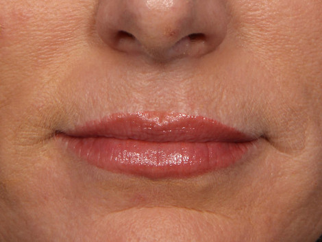 Wrinkle Reduction before and after photo