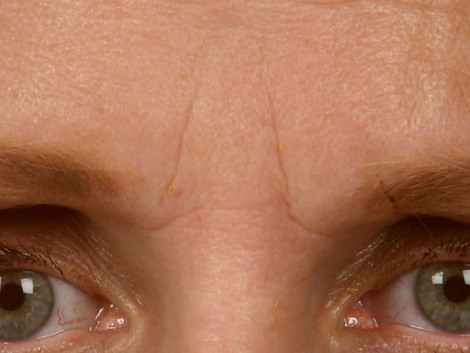 Wrinkle Reduction before and after photo