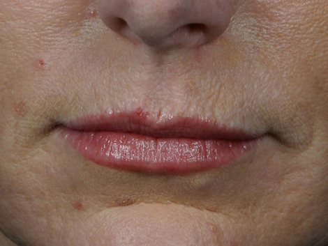 Wrinkle Reduction before and after photo