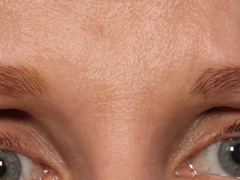 Wrinkle Reduction before and after photo