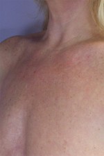 Chemical Peels Before and after photo