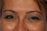 BOTOX® Cosmetic Before and after photo