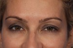 BOTOX® Cosmetic Before and after photo