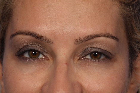 BOTOX® Cosmetic before and after photo