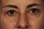 BOTOX® Cosmetic Before and after photo