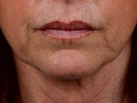 Thermage® before and after photo