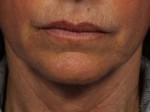 Thermage® Before and after photo