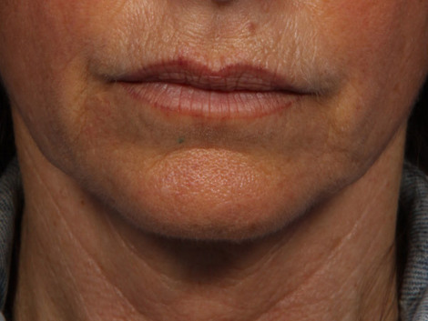 Thermage® before and after photo